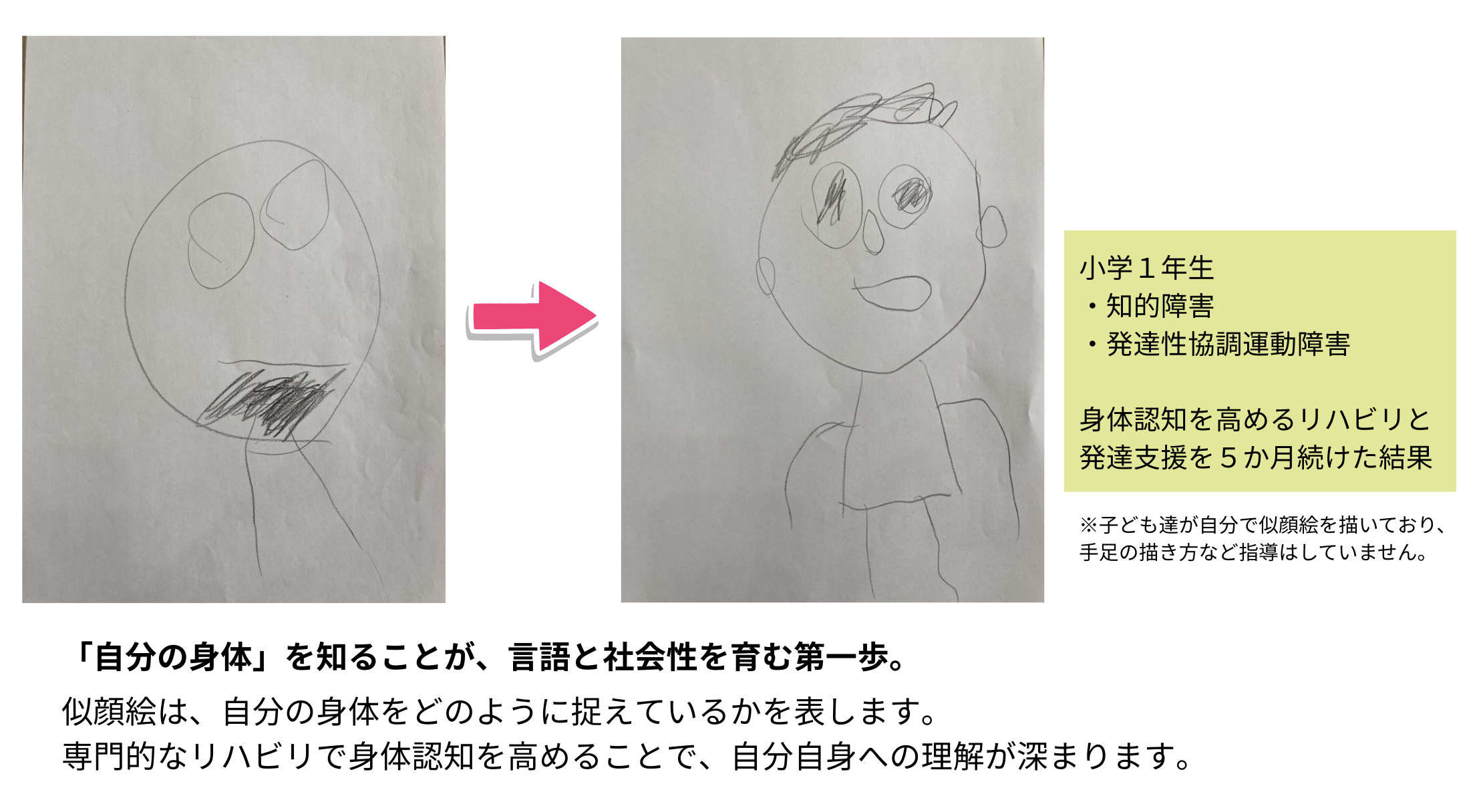 小学1年生の似顔絵ビフォーアフター。5ヶ月のリハビリで身体認知が向上し描画が変化