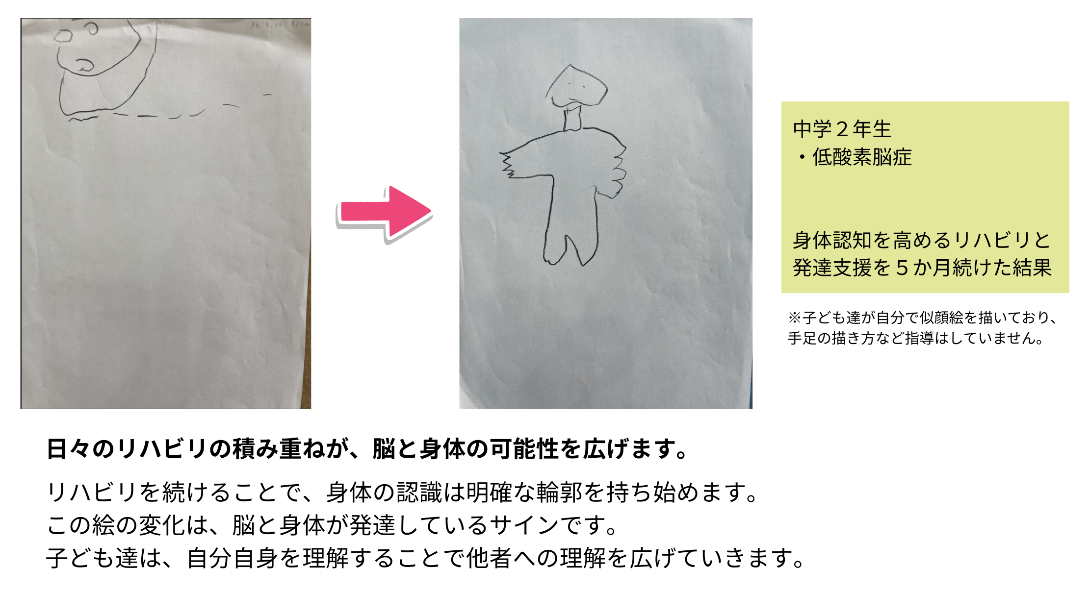 中学2年生の全身画ビフォーアフター。リハビリ継続によるボディスキーマの発達と表現の変化
